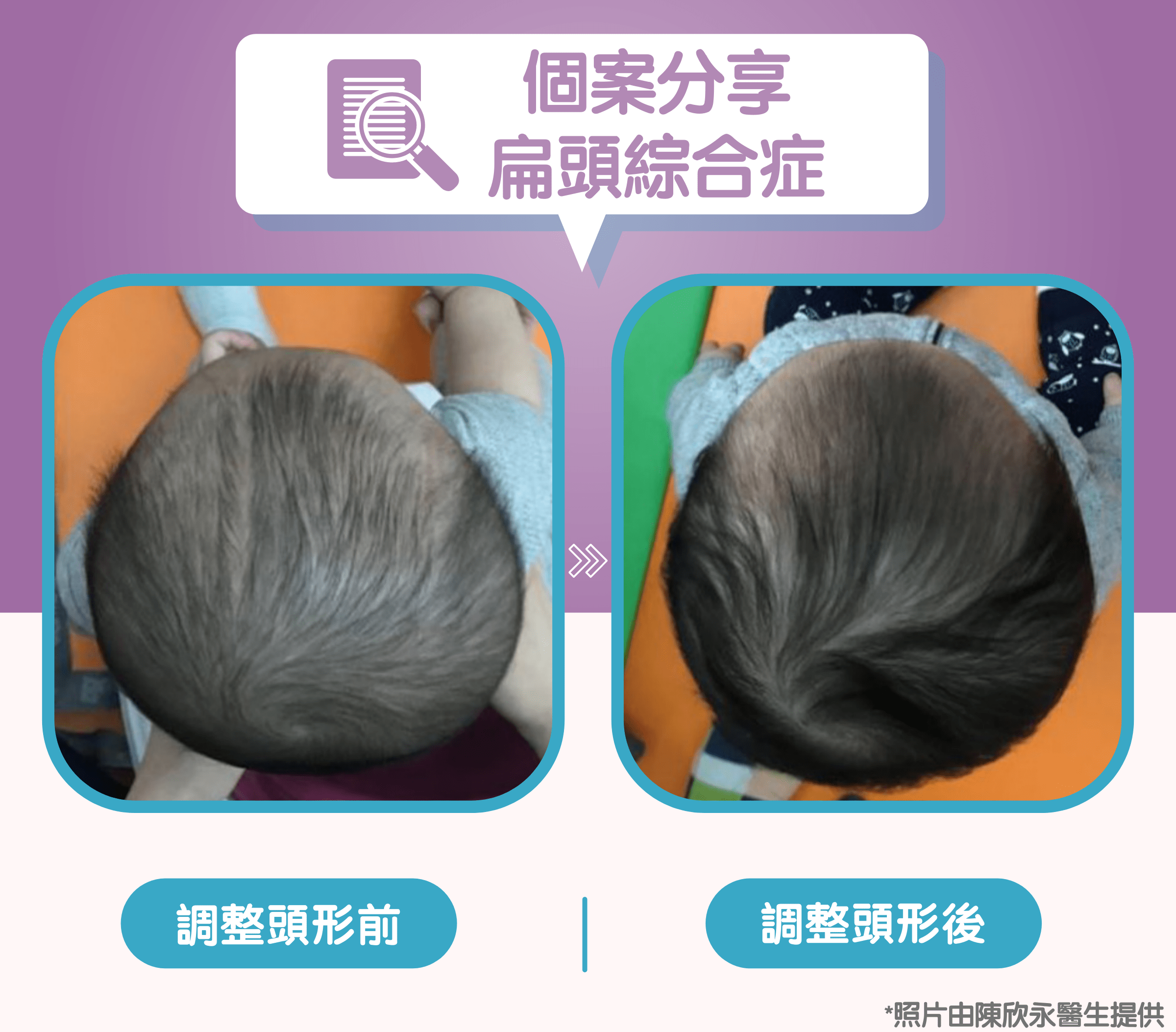 兒童扁頭綜合症