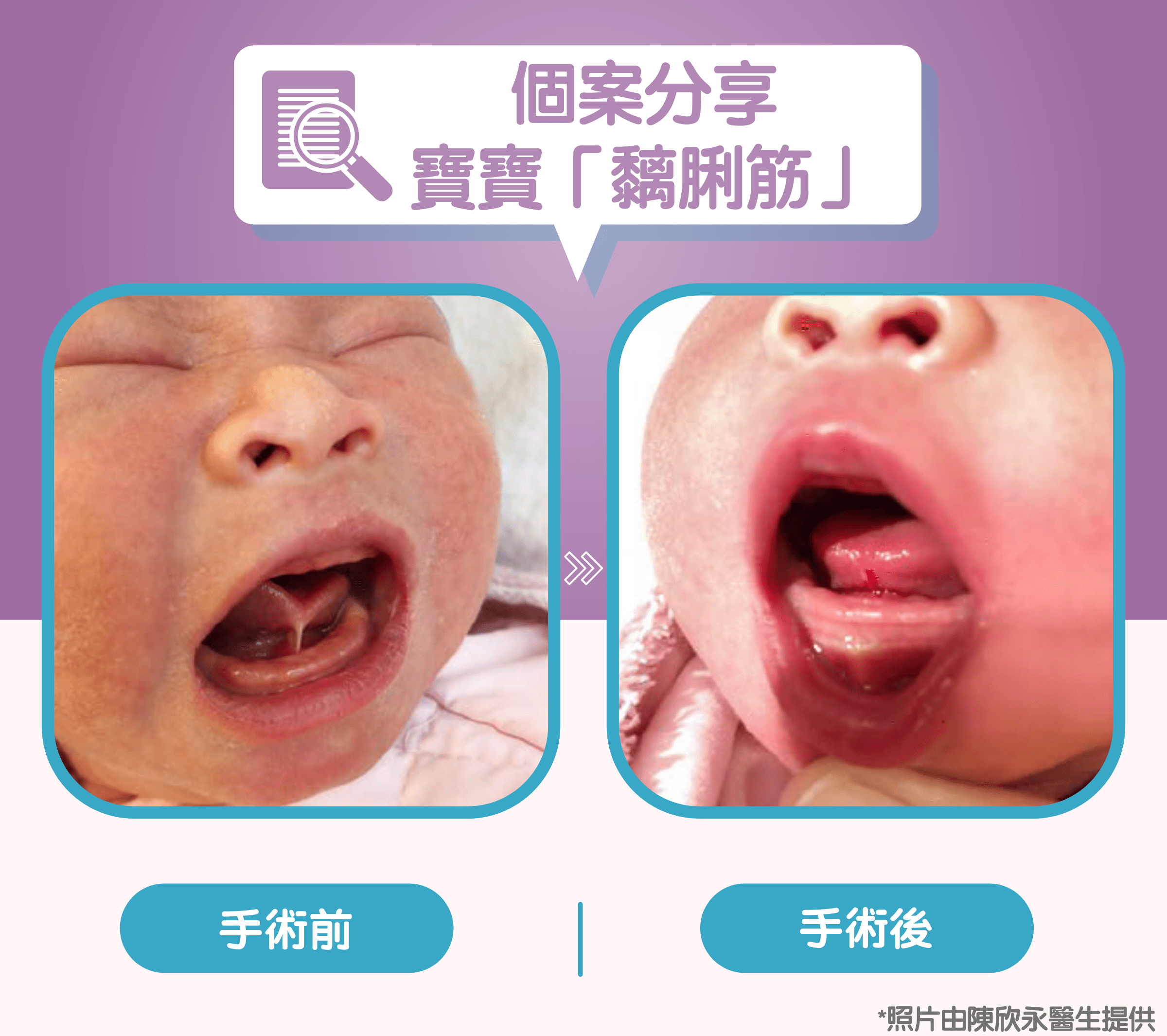 剪脷筋 (舌繫帶釋放術)